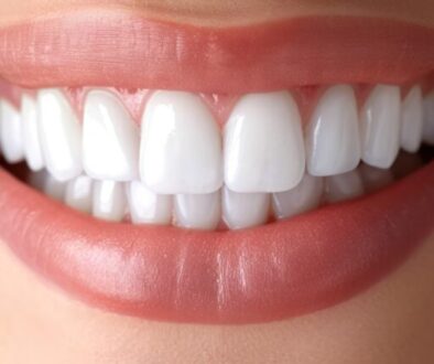 dental veneers close-up